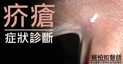 小瘡|疥瘡的照護準則